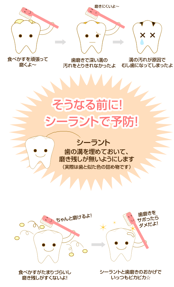 シーラント