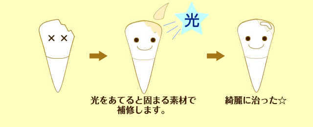 歯が欠けてしまった場合