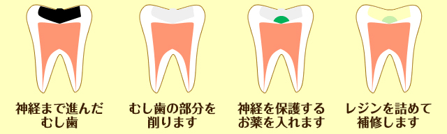 乳歯のむし歯の治療(中度)