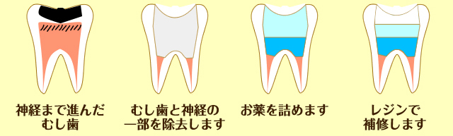 乳歯のむし歯の治療(中度)