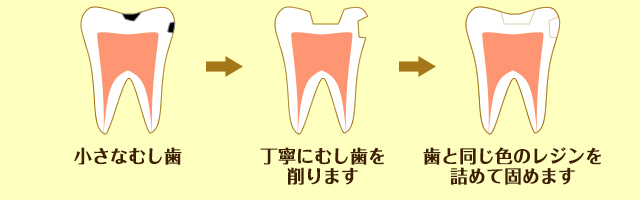 小さなむし歯の治療