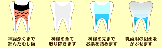 乳歯のむし歯の治療（中度）